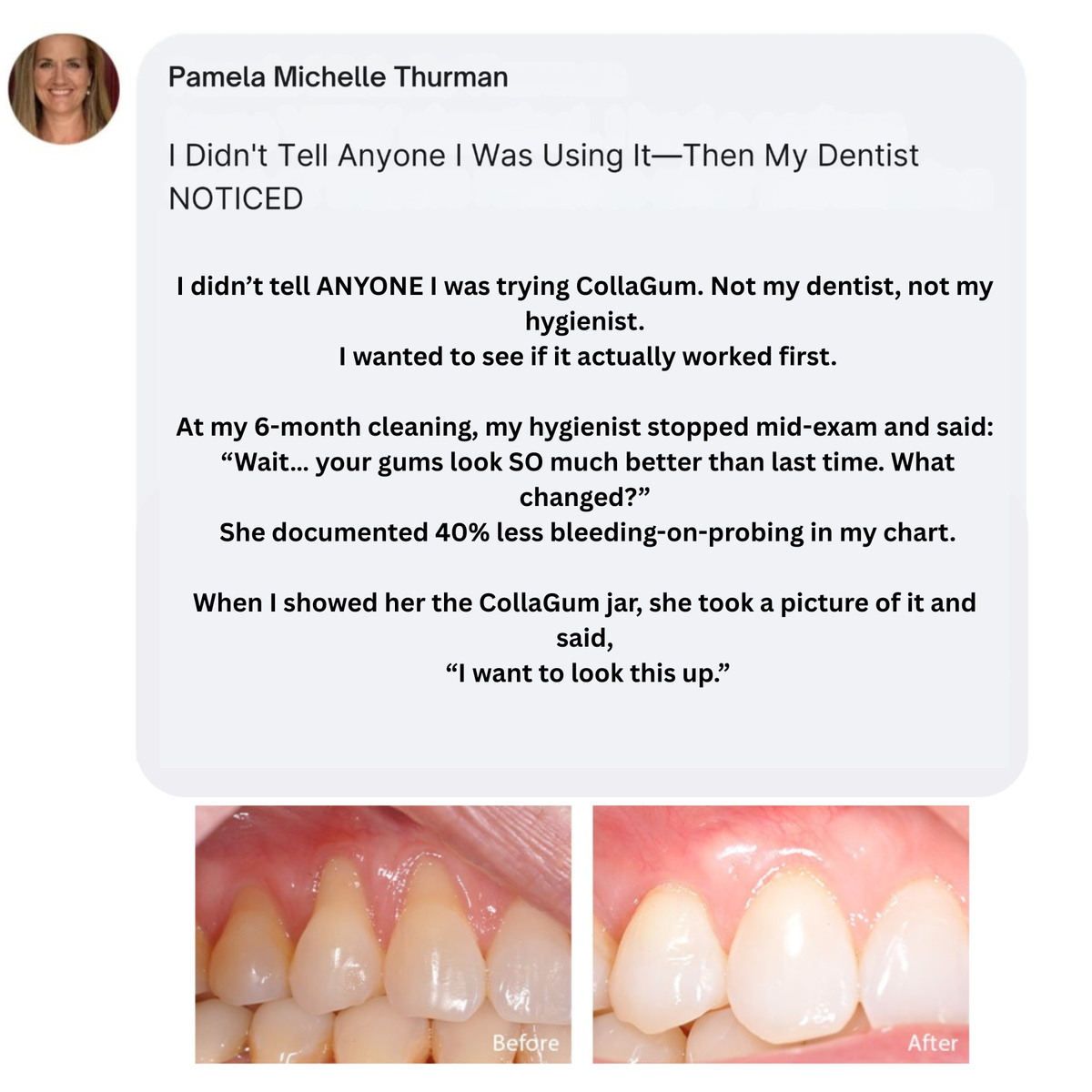 CollaGum™ – Daily Support for Receding Gums, Sensitivity & Gum Weakness