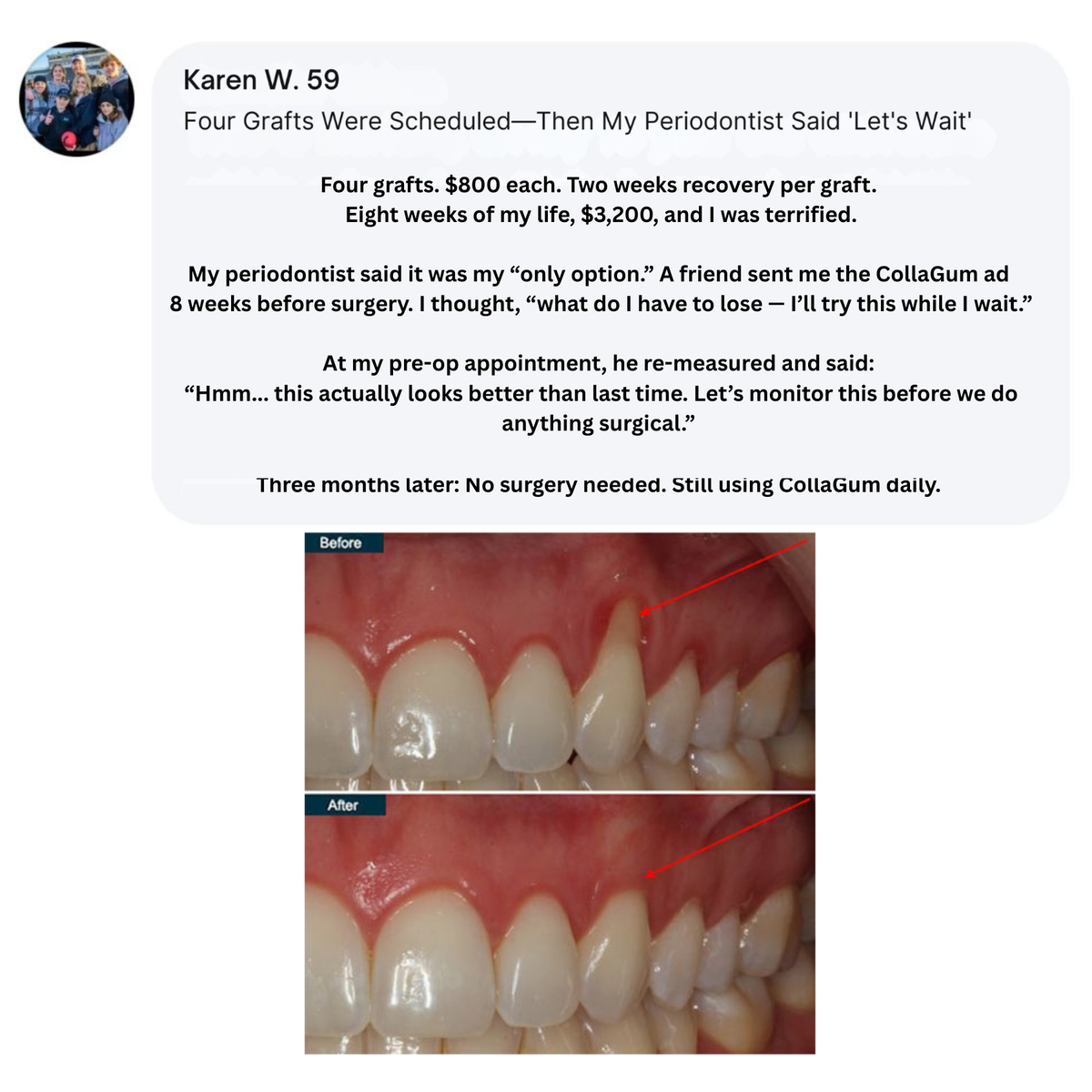 CollaGum™ – Daily Support for Receding Gums, Sensitivity & Gum Weakness
