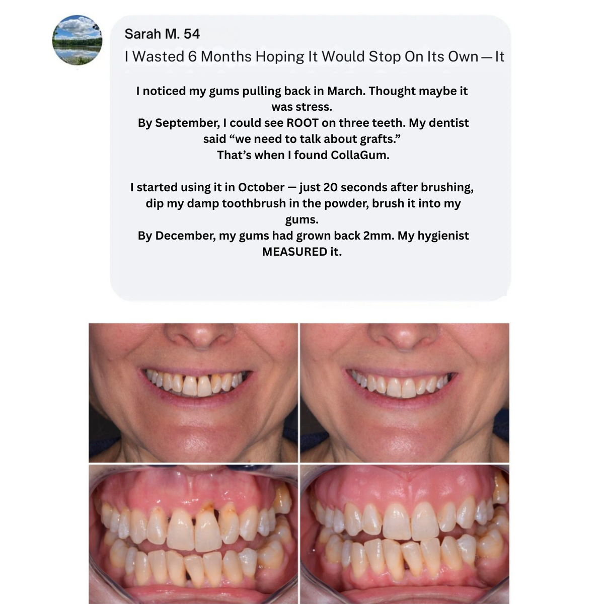 CollaGum™ – Daily Support for Receding Gums, Sensitivity & Gum Weakness