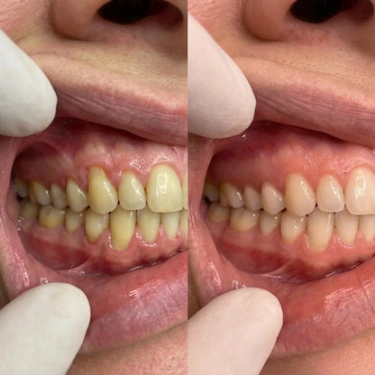 CollaGum™ – Daily Support for Receding Gums, Sensitivity & Gum Weakness